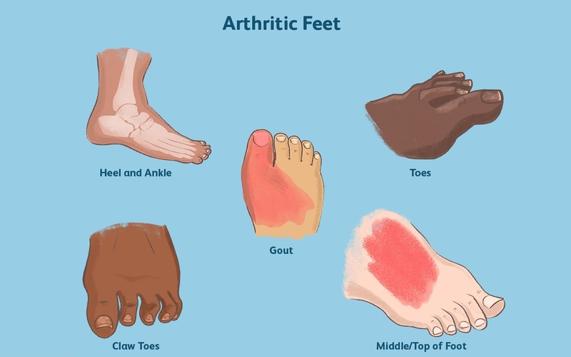 Tìm hiểu ngay 5 nguyên nhân nóng rát bàn chân để xử lý kịp thời! 2