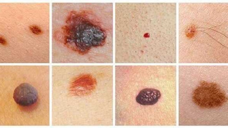 Tìm hiểu nguyên nhân, triệu chứng và cách chẩn đoán u hắc tố lành tính 1