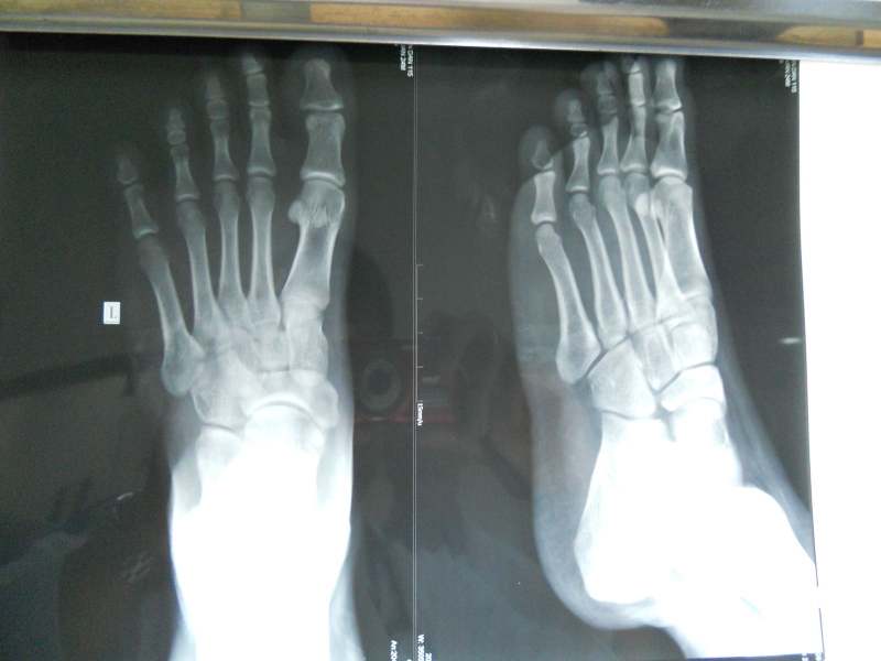 Tìm hiểu nguyên nhân, triệu chứng và cách điều trị bong gân bàn chân 2