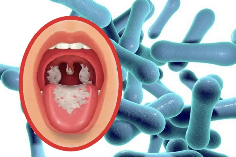 Tìm hiểu nguyên tắc và các cách điều trị bệnh bạch hầu 3