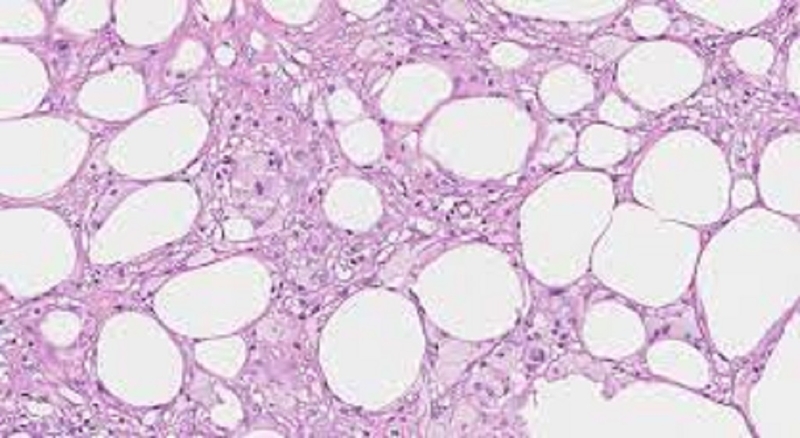 Tìm hiểu những thông tin bạn cần biết về thoái hóa và hoại tử tế bào 4