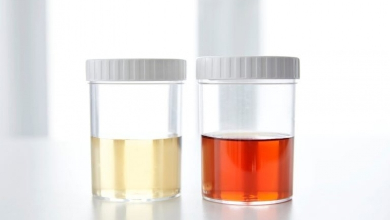 Tìm hiểu nước tiểu khi có thai màu gì? Khi nào cần đi khám? 2