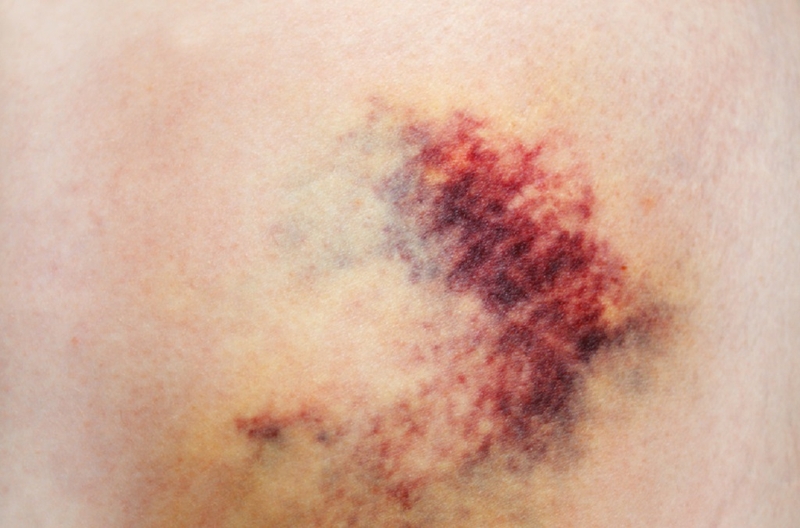 Tìm hiểu ổ tụ máu là gì? Nguyên nhân, triệu chứng và biện pháp phòng tránh 1