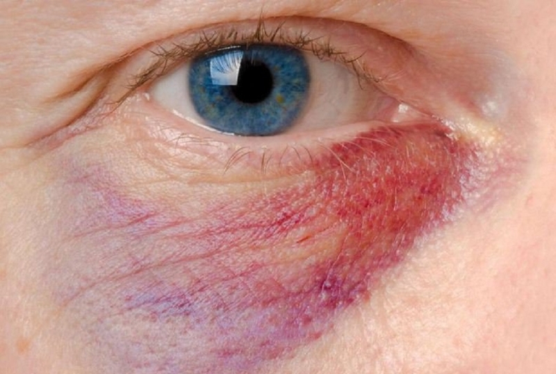 Tìm hiểu ổ tụ máu là gì? Nguyên nhân, triệu chứng và biện pháp phòng tránh 4