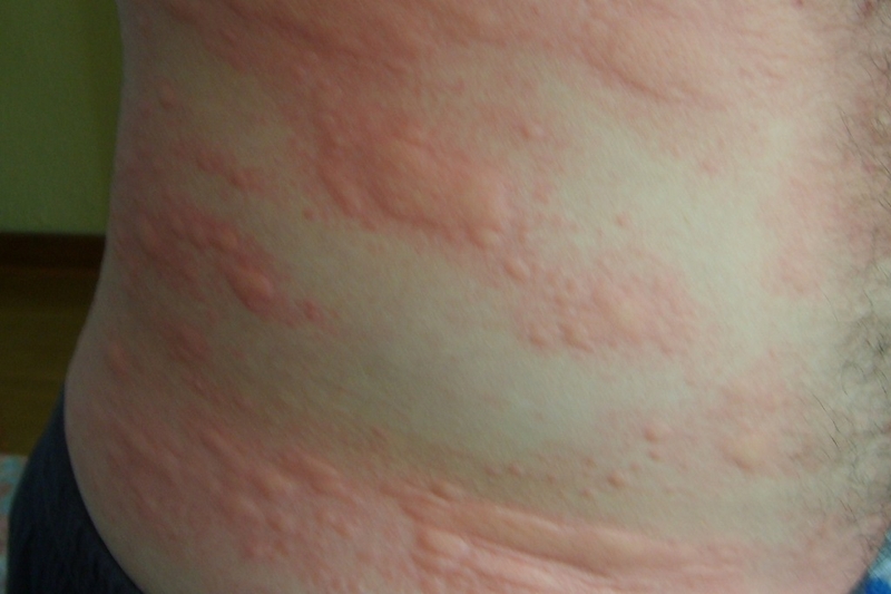 Tìm hiểu phương pháp chữa bệnh dị ứng thời tiết dứt điểm 2