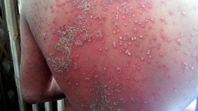 Tìm hiểu phương pháp điều trị bệnh vảy nến hiệu quả