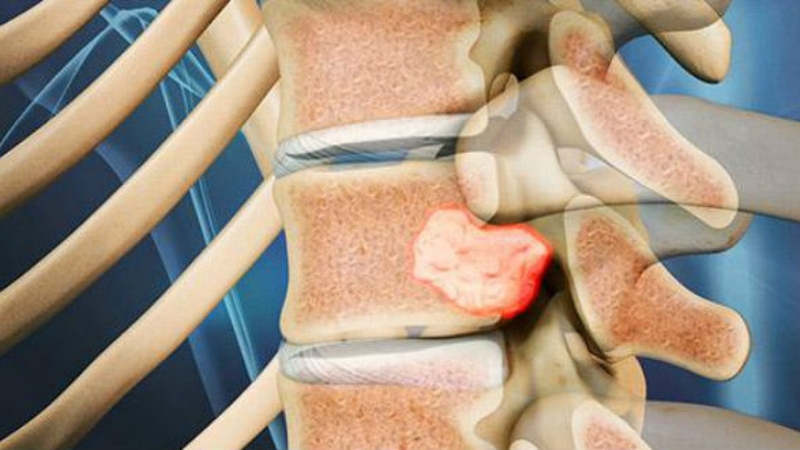 Nắn chỉnh cột sống bằng tay không phù hợp với những bệnh nhân bị u cột sống