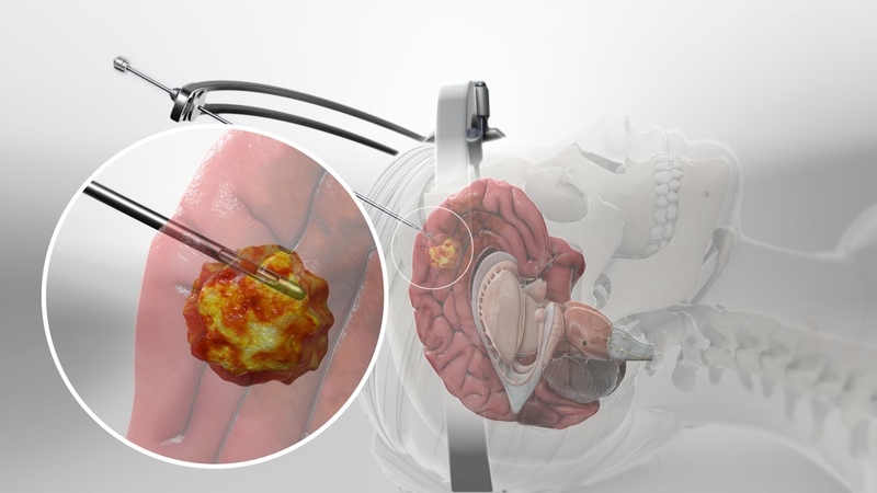 Tìm hiểu về sinh thiết não dưới cắt lớp vi tính 3