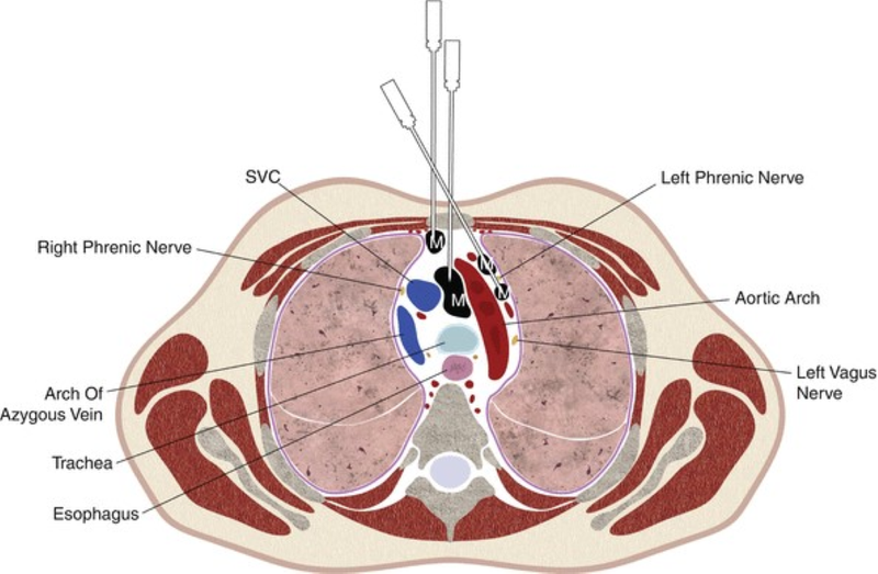Tìm hiểu về sinh thiết trung thất dưới cắt lớp vi tính 3