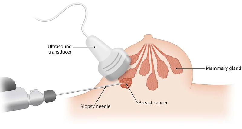 Tìm hiểu sinh thiết vú dưới hướng dẫn siêu âm 3
