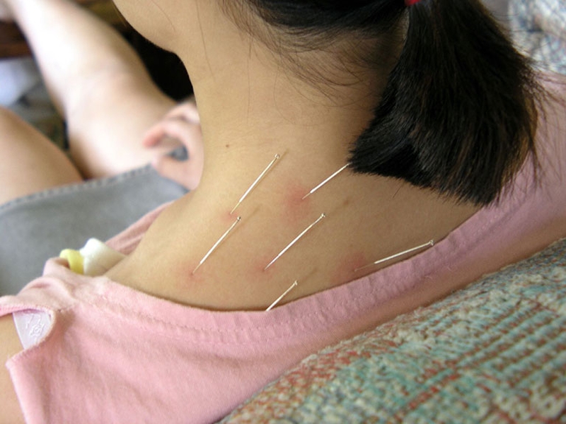 Châm cứu tại huyệt kiên tỉnh là một biện pháp phổ biến trong trị liệu đau mỏi vai gáy