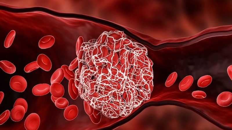 Tìm hiểu tình trạng xuất huyết tiêu hóa giãn vỡ tĩnh mạch thực quản 1