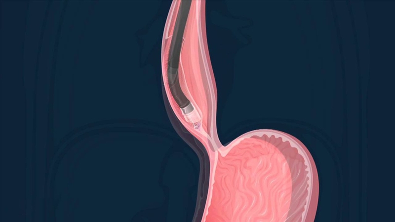 Tìm hiểu tổng quan về kỹ thuật mở cơ đường miệng 3