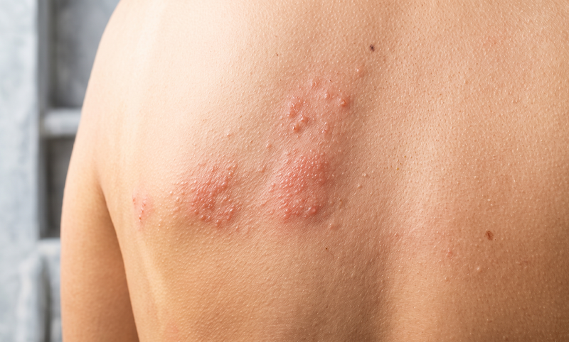 Tìm hiểu từ A đến Z về virus zona và cách phòng ngừa hiệu quả 2