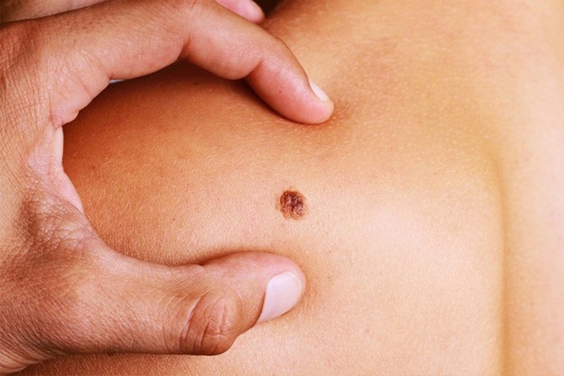 Tìm hiểu ung thư da hắc tố di căn hay không? 1