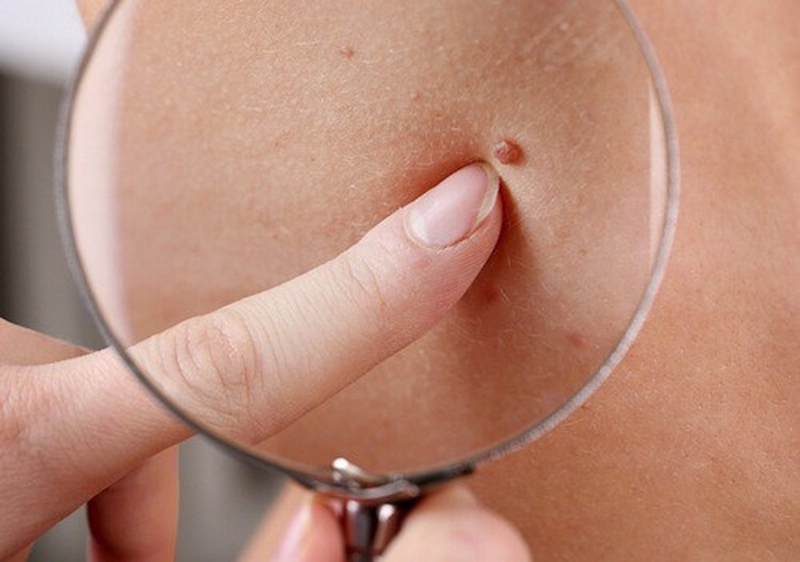 Tìm hiểu ung thư da hắc tố di căn hay không? 2