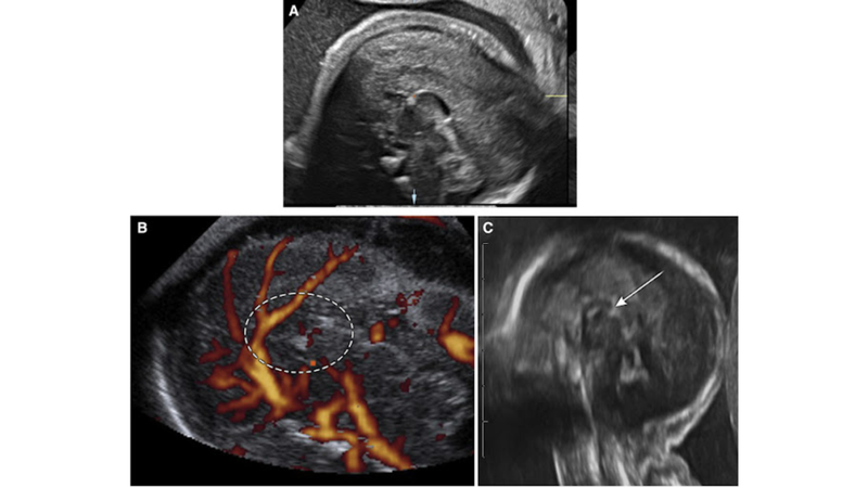 Tìm hiểu về bất sản thể chai 3