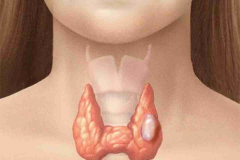 Tìm hiểu về bệnh lý bướu cổ vôi hóa là gì? 1