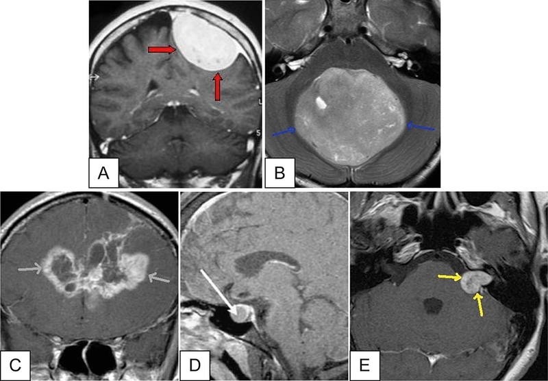 Tìm hiểu về các các loại u não phổ biến hiện nay3