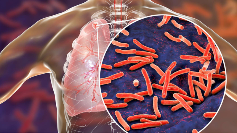 Tìm hiểu về các giai đoạn của lao phổi và phương pháp điều trị 1