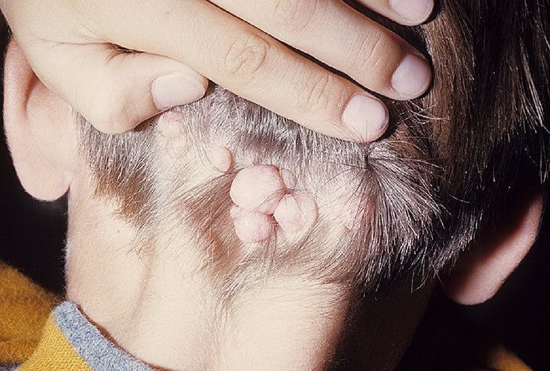 Tìm hiểu về các loại u da lành tính phổ biến nhất và cách xử lý tình trạng này 2