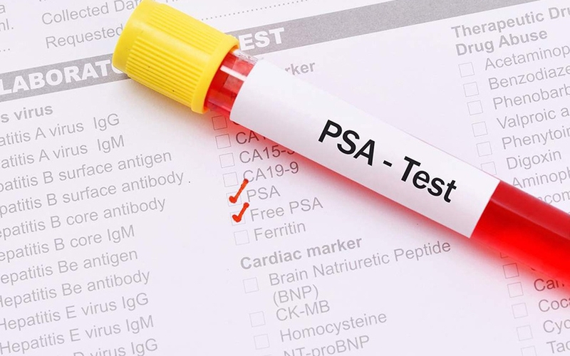 Tìm hiểu về các loại xét nghiệm dấu ấn ung thư thường được sử dụng 4