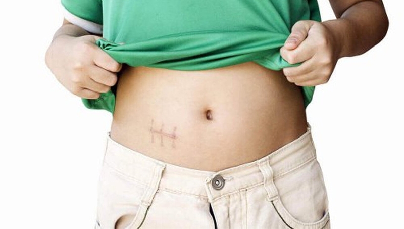 Tìm hiểu về các phương pháp phẫu thuật ruột thừa 1