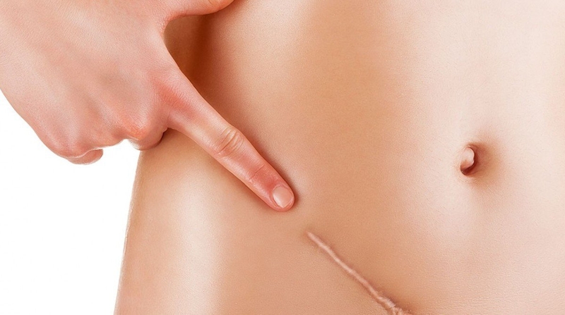 Tìm hiểu về các phương pháp phẫu thuật ruột thừa 2