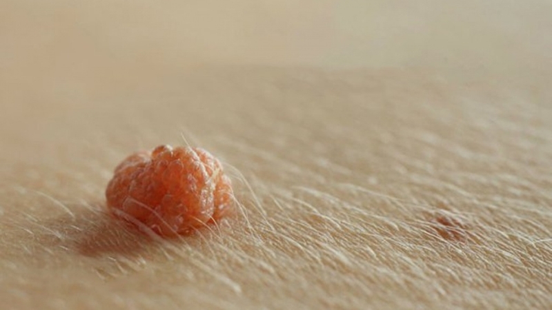 Tìm hiểu về các tác nhân gây mụn cóc và cách điều trị 3