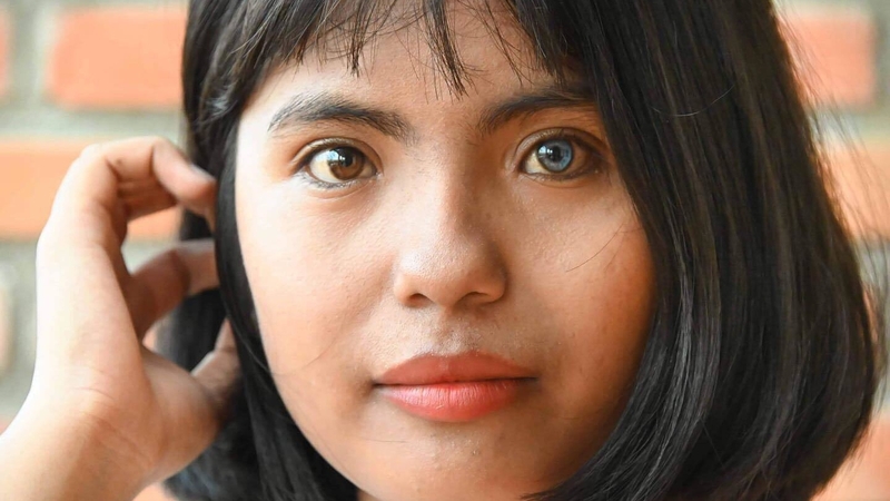 Tìm hiểu về chứng loạn sắc tố mống mắt 1