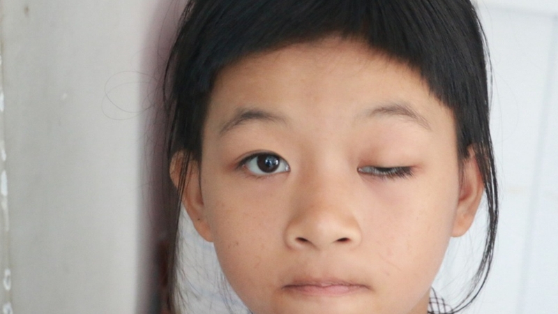 Tìm hiểu về chứng loạn sắc tố mống mắt 3