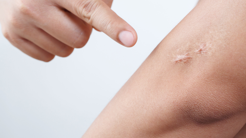 Tìm hiểu về cơ chế hình thành sẹo và những điều cần lưu ý khi trị sẹo 1