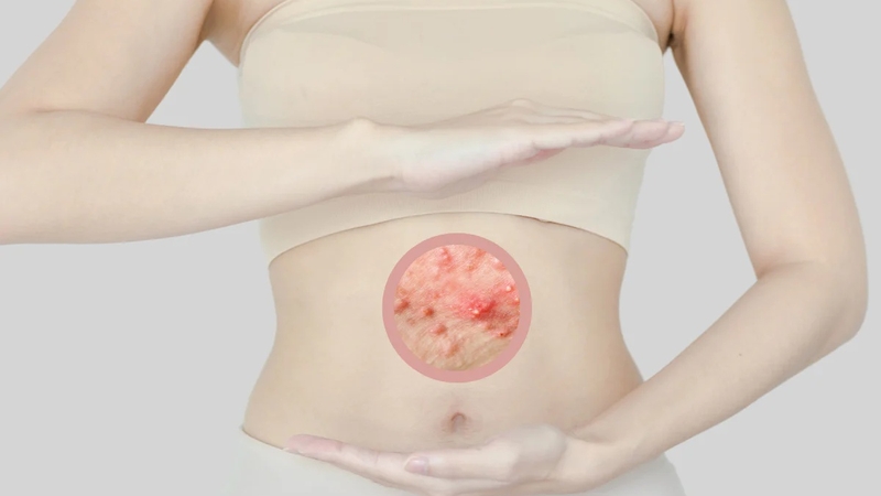 Tìm hiểu về điều trị nổi mụn ở bụng như thế nào? 2