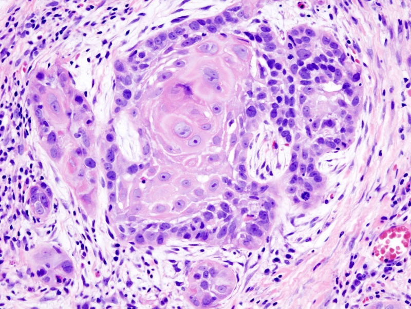 Tìm hiểu về  đột biến gen IDH1 và IDH2 ở các bệnh nhân ung thư 4