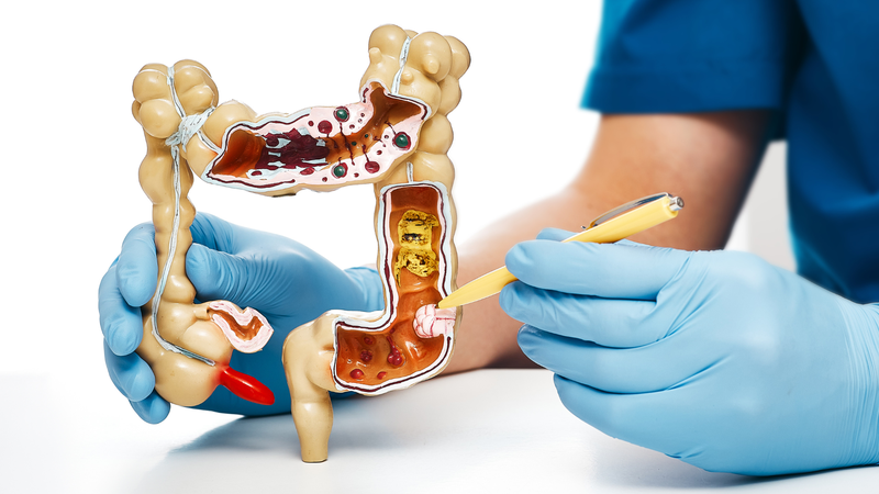 Tìm hiểu về hố ngồi trực tràng: Cấu trúc, chức năng và các bệnh liên quan 2