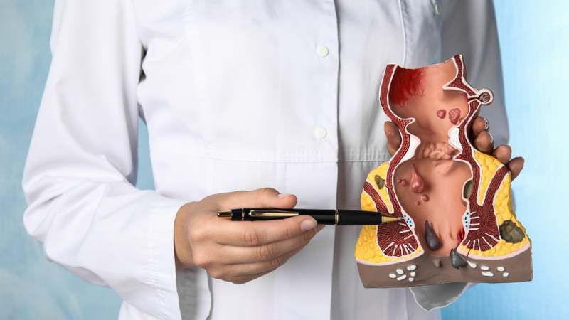 Tìm hiểu về hố ngồi trực tràng: Cấu trúc, chức năng và các bệnh liên quan 1