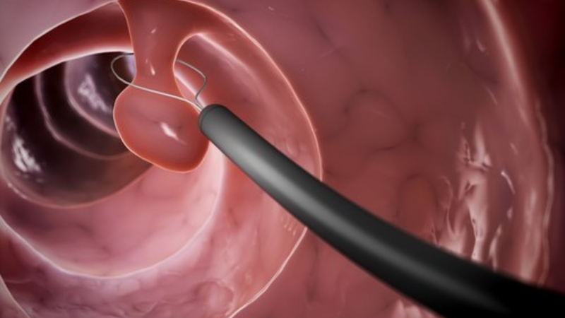 Tìm hiểu về khối u dạ dày lành tính và ác tính 1