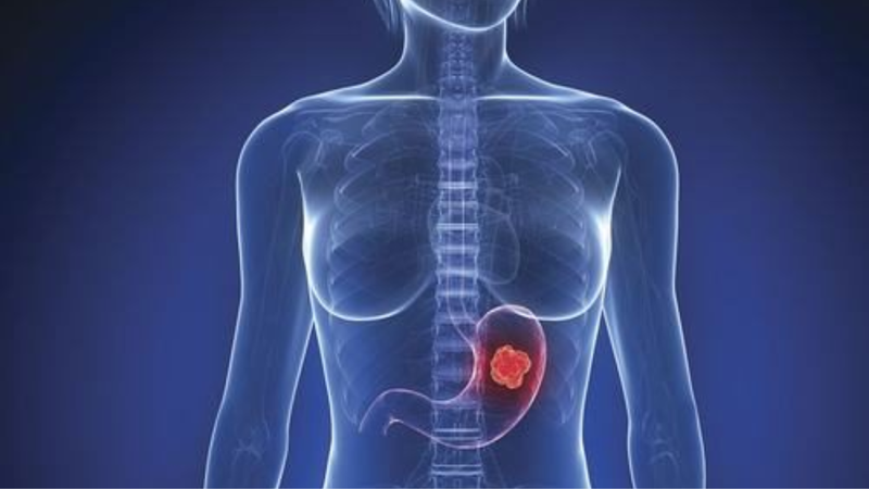 Tìm hiểu về khối u dạ dày lành tính và ác tính 2