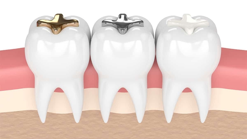 Tìm hiểu về kĩ thuật hàn răng và quy trình hàn răng 1