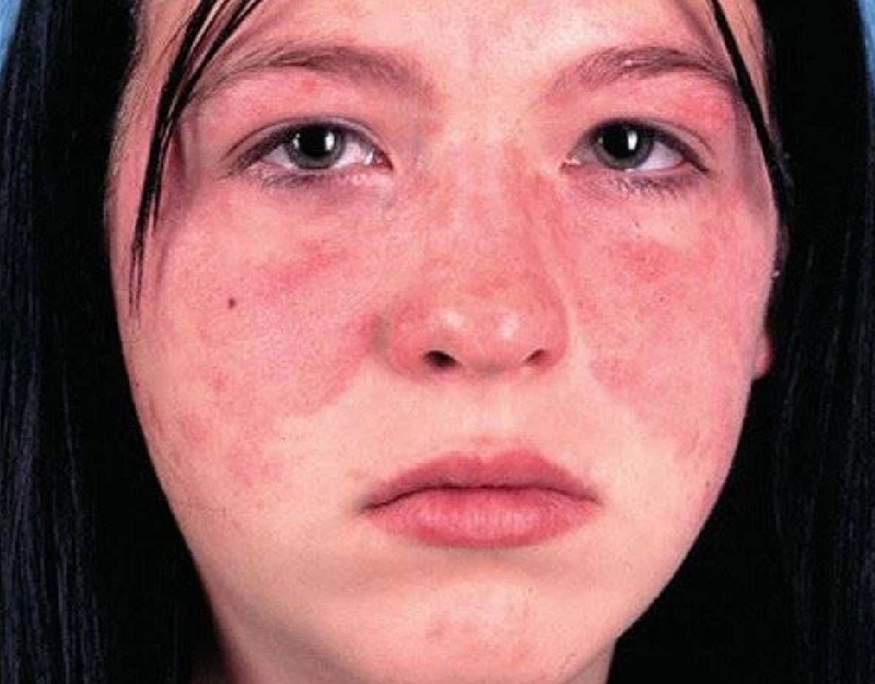 Tìm hiểu về lupus ban đỏ hệ thống mãn tính 1