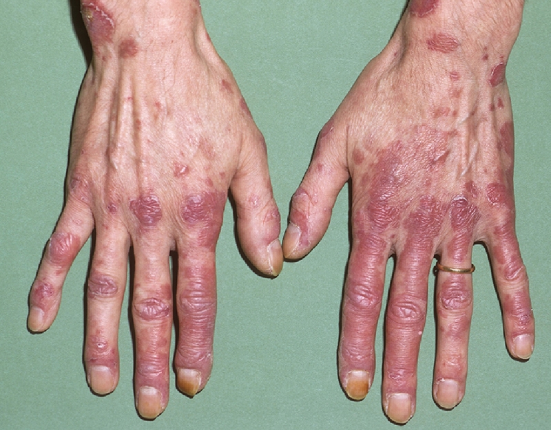 Lupus ban đỏ hệ thống là một bệnh mãn tính 2