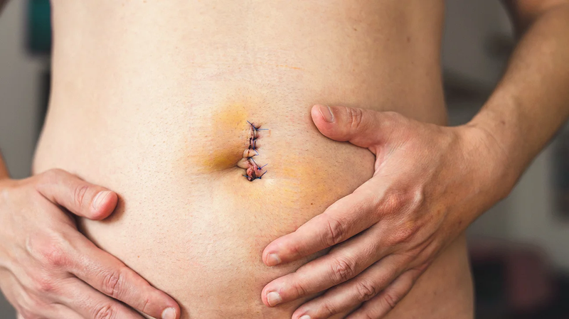 Tìm hiểu về một số loại chỉ khâu vết thương 2