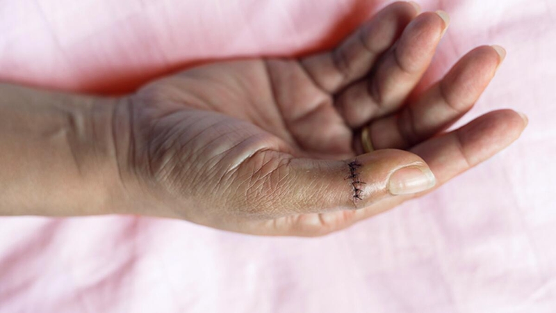 Tìm hiểu về một số loại chỉ khâu vết thương 4