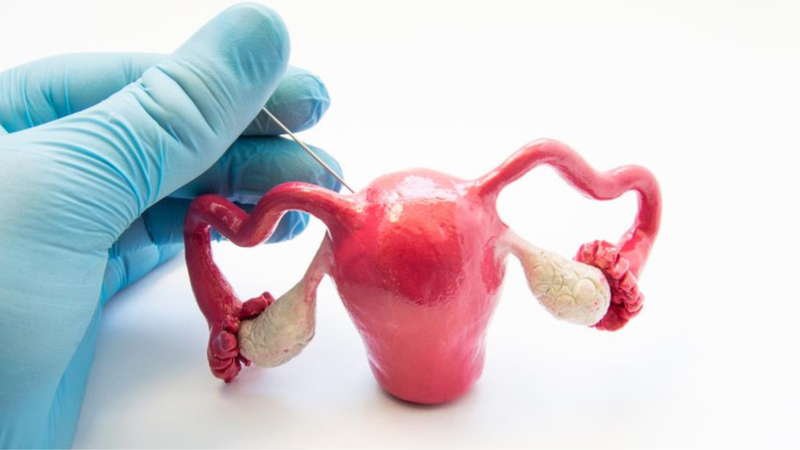 PCOS và u nang buồng trứng là những vấn đề phụ khoa phổ biến và gây nhiều lo lắng ở phụ nữ