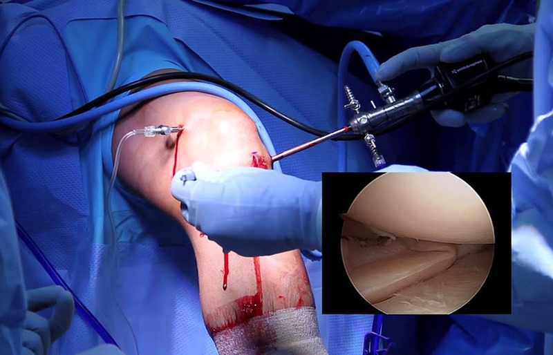 Tìm hiểu về phẫu thuật rách sụn chêm2