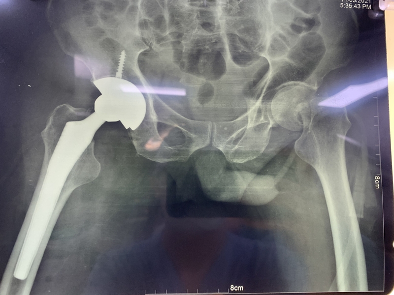 Tìm hiểu về phẫu thuật thay khớp háng ở người già 2