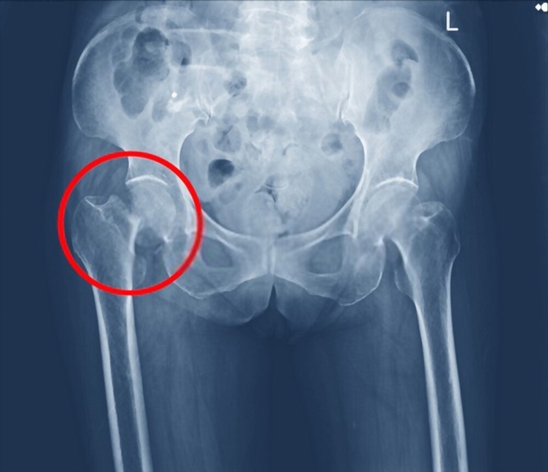 Tìm hiểu về phẫu thuật thay khớp háng ở người già 1