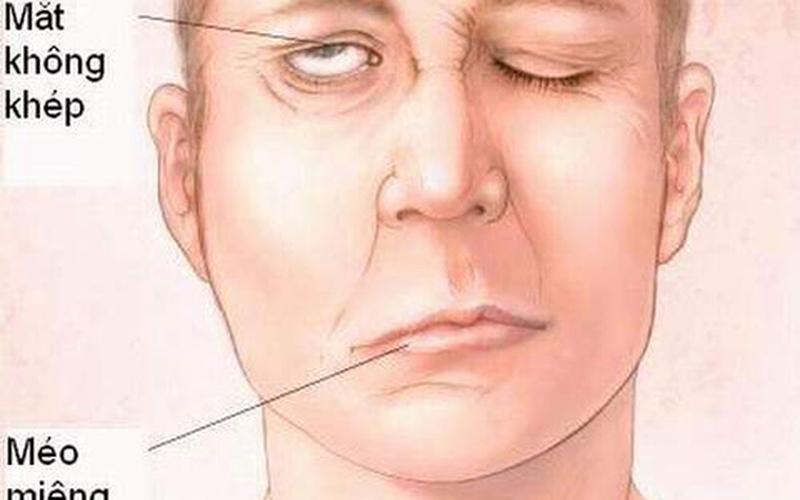 Tìm hiểu về phương pháp bấm huyệt chữa méo miệng, liệt mặt1