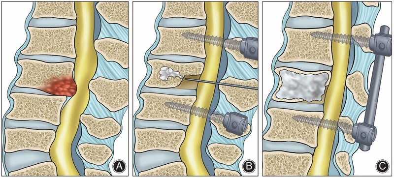 Tìm hiểu về phương pháp bơm xi măng cột sống điều trị xẹp đốt sống 2