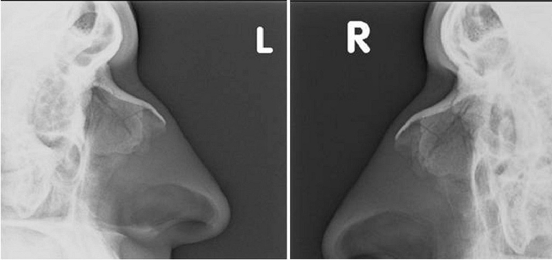 Tìm hiểu về phương pháp chụp X-quang Hirtz trong chẩn đoán viêm xoang 2